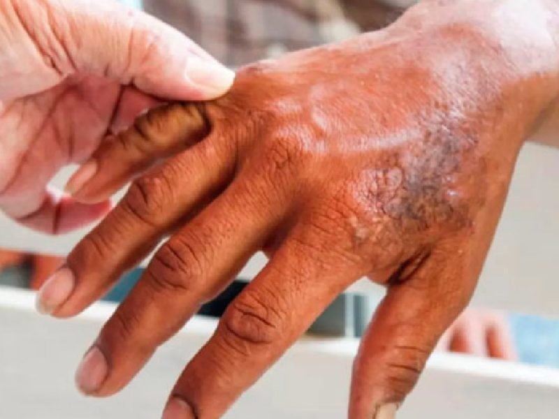 Reportan cuatro casos de lepra en Guanajuato; abren áreas derma en Farmacias ISSEG