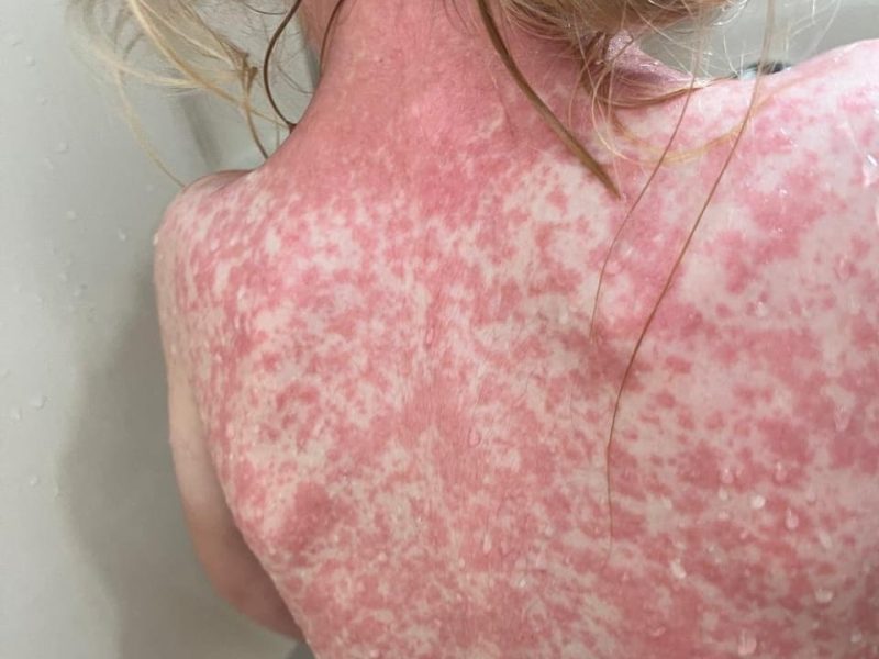 Sarampión en Hidalgo: registran seis casos