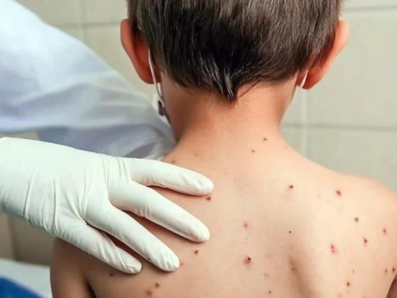 Alerta sanitaria: Se extienden casos de sarampión en México a las 32 entidades