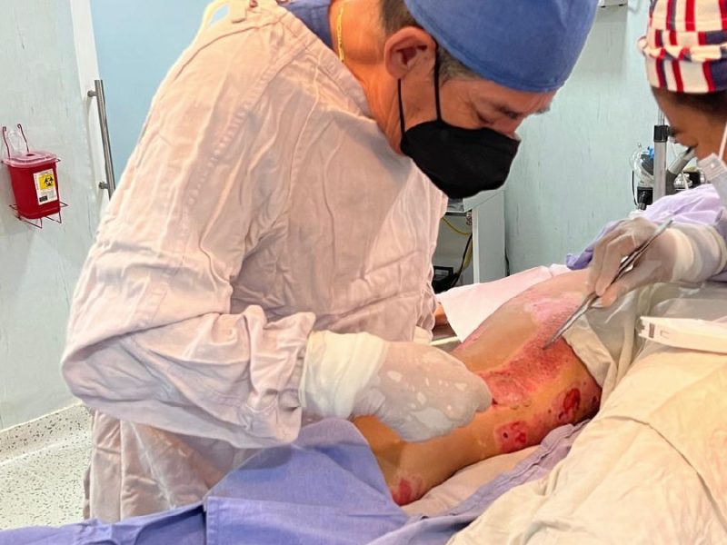 Niños, los más afectados por quemaduras en Guanajuato: 77 casos reportados en 2025