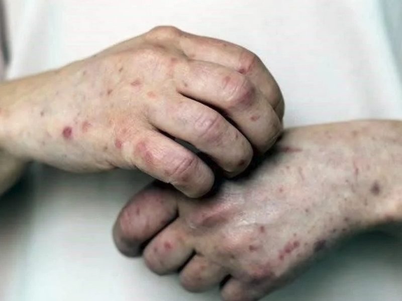 Crisis de sarampión en México: en 20 días de enero contabilizan 1,153 contagios