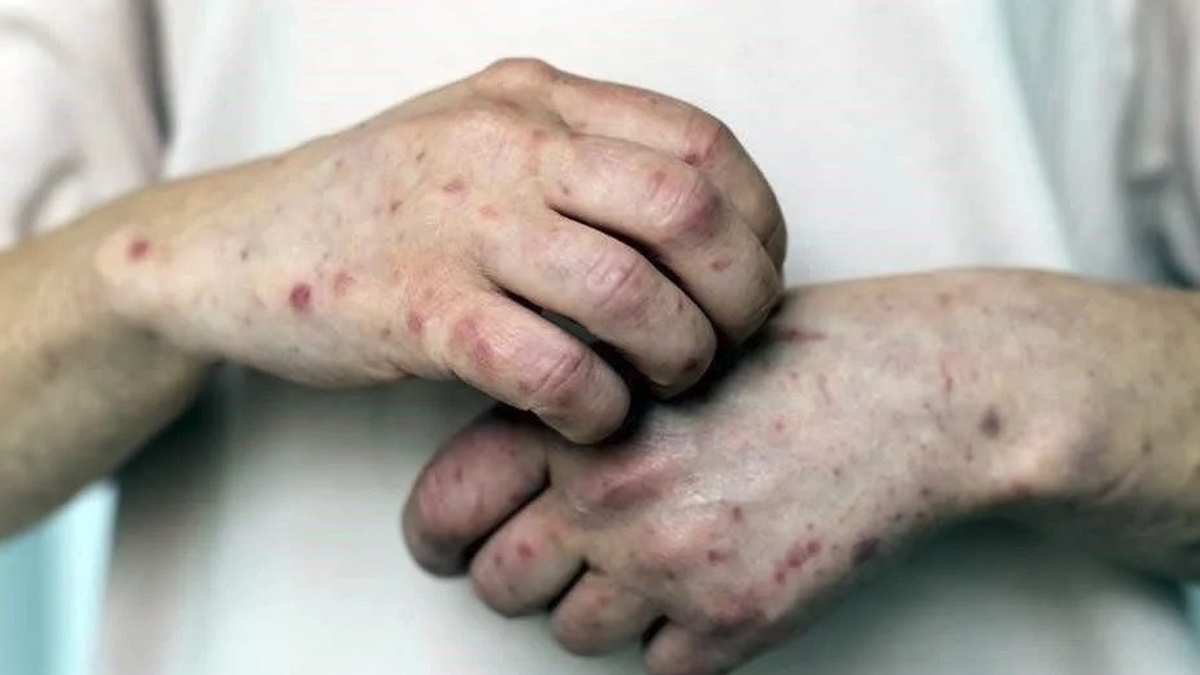 Sarampión en México