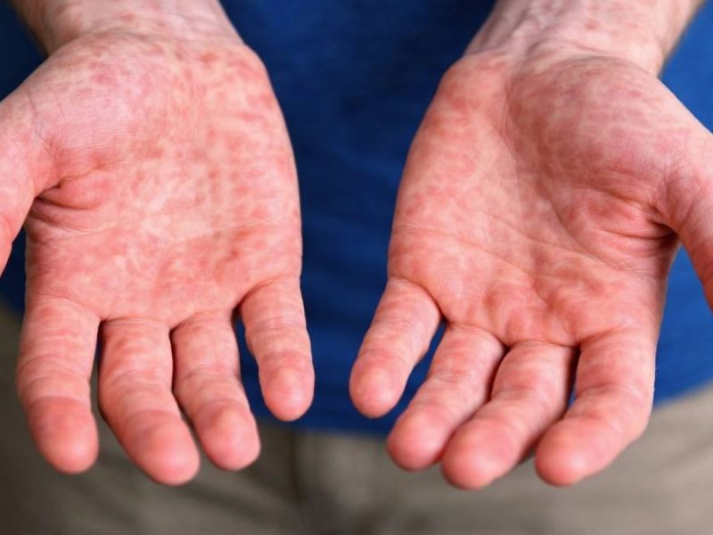 Culpan a gobiernos pasados por falla en vacunación contra sarampión: Cobertura cayó al 47%