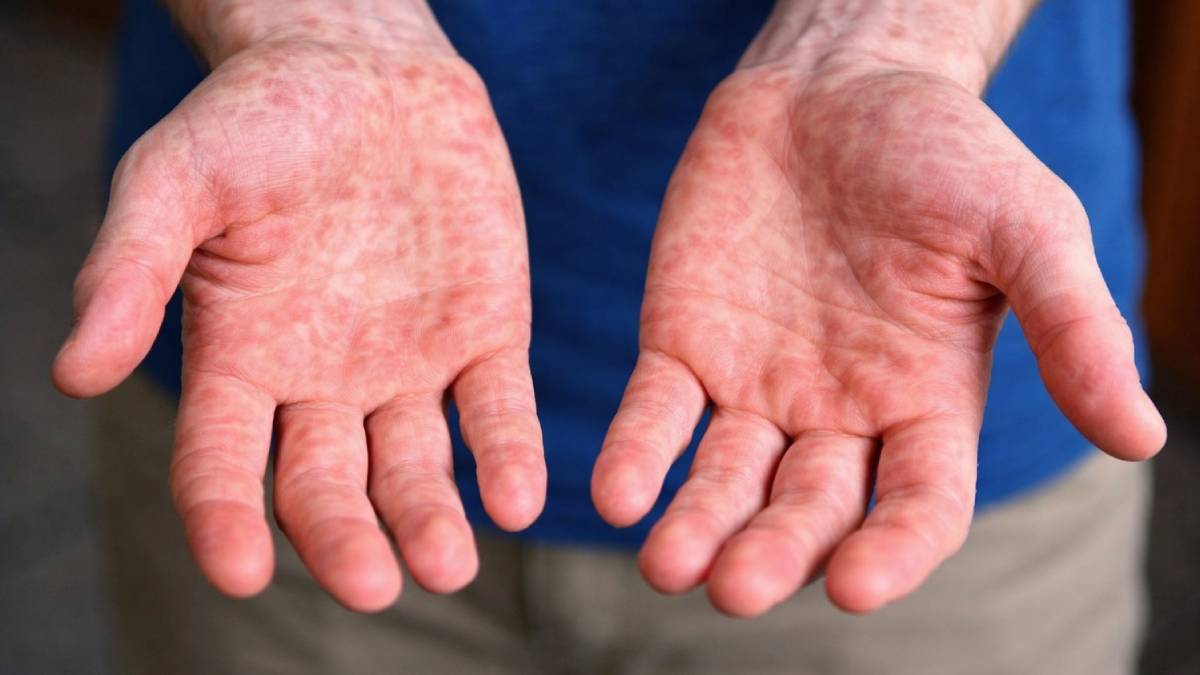 vacunacion-contra-sarampion