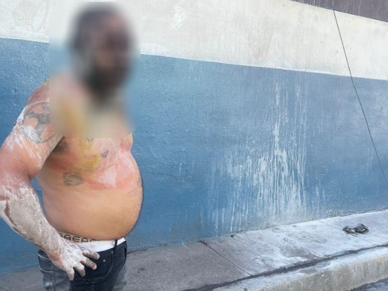 Hombre sufre severas quemaduras en Irapuato; indagan si le arrojaron solvente o fue accidental
