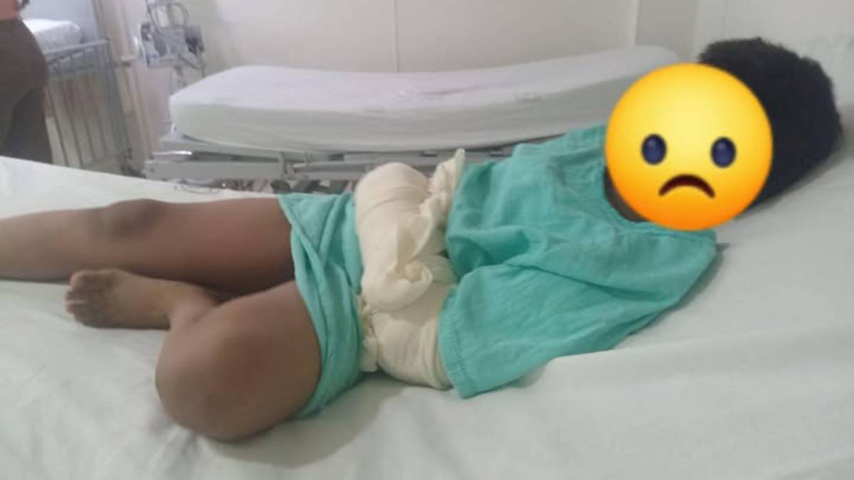 fracturado-t-21-imss